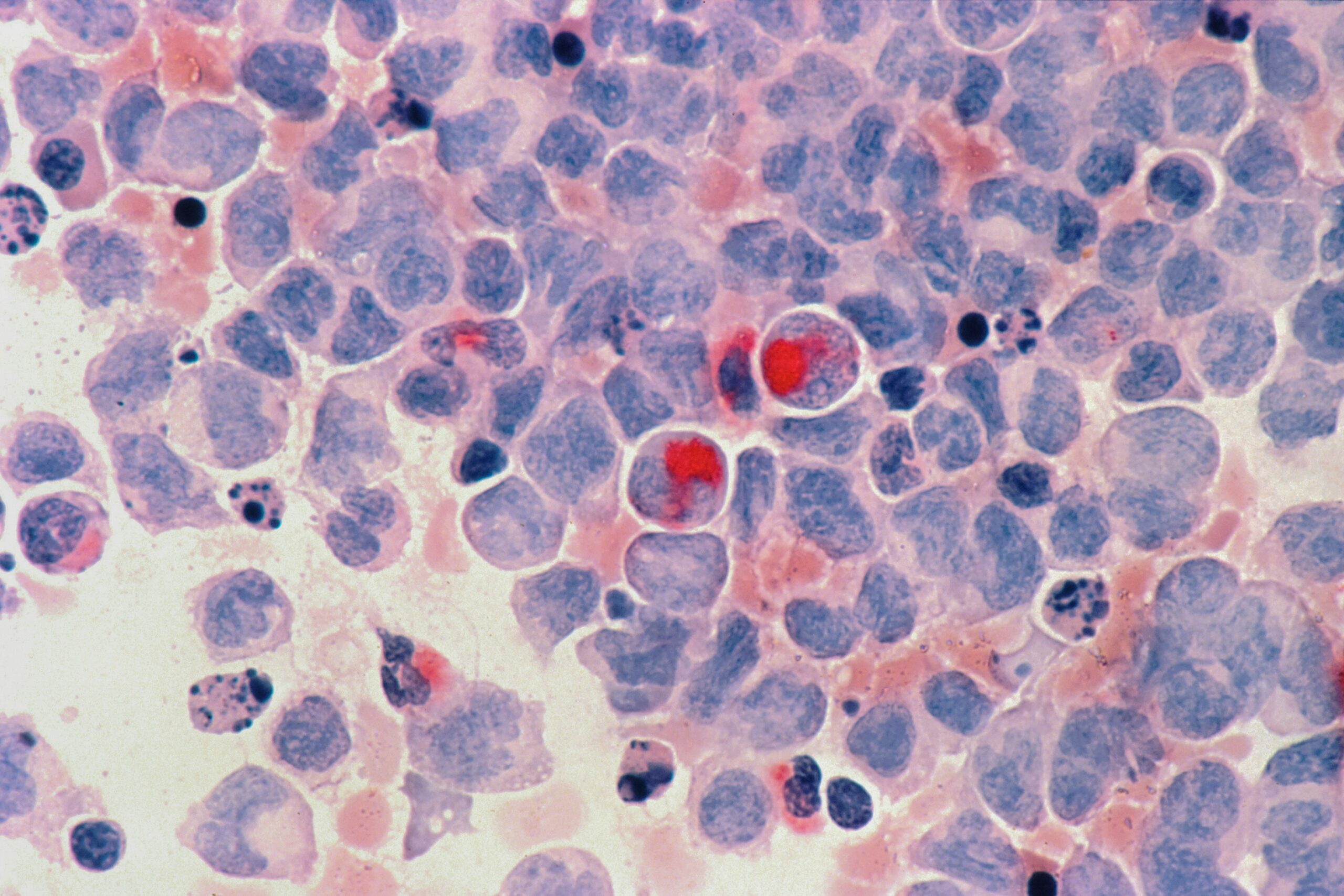 Microscopic image of a blood smear containing cancer cells