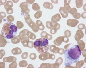 Eosinophils are a type of WBC which protect from parasites, fungi & allergens.  