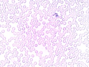 Manual differential smear showing white blood cells, red blood cells and platelets. 