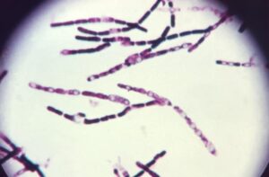 Gram stain of Bacillus anthracis, seen as gram positive bacillus with spores. 
