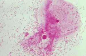 Gram stain of Gardnerella vaginalis, seen as gram variable bacilli. Clue cells, can also be observed. 
