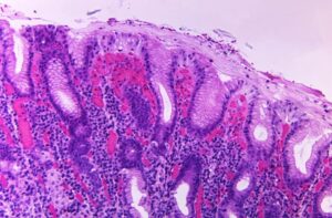 What Happens To Biopsy Tissue After Removal? A Histology Overview