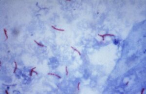 Acid fast stain of Mycobacterium tuberculosis, seen as pink bacilli amongst a blue background. 